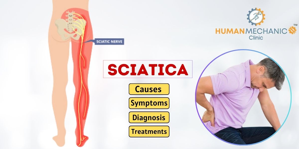 Sciatica - causes, Symptoms, Diagnosis and Treatments