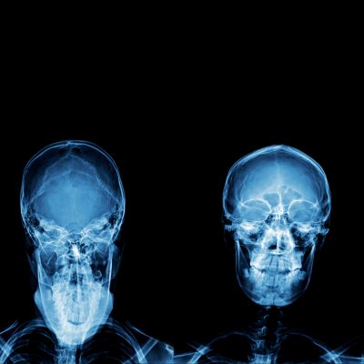 Subluxation 3 blue-image-human-skull-with-brain-highlighted